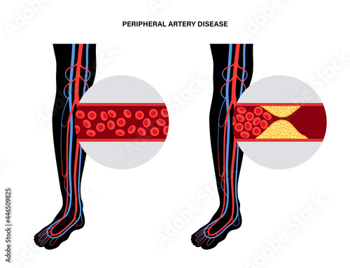 Peripheral artery disease