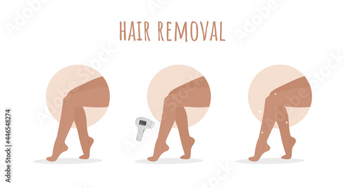 Hair removal. Laser epilation. Perfect smooth female legs. Before and after. Step by step procedure of depilation. Vector illustration in flat cartoon style. Skin care concept.