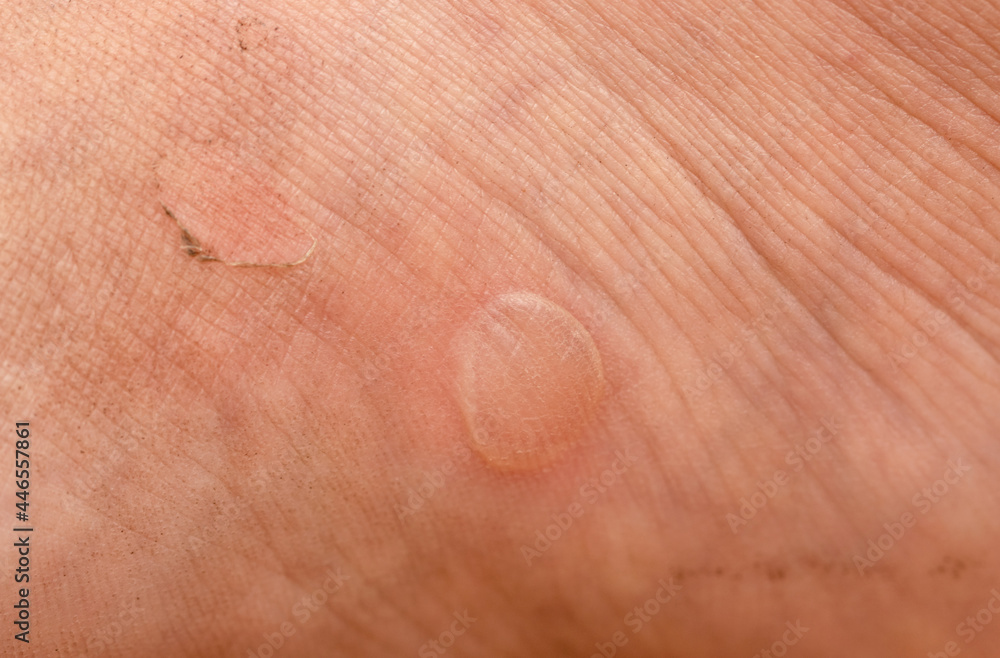callus from shoes as a background callus from shoes as a background