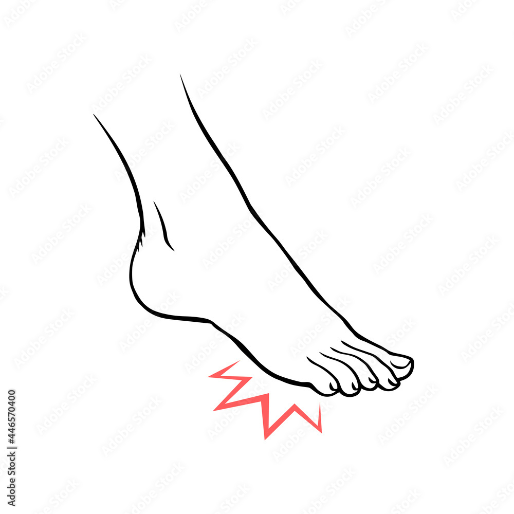 Leg with heel pain. Orthopedic disease. Foot health problems. Vector isolated outline illustration hand drawn Leg with heel pain. Orthopedic disease. Foot health problems. Vector isolated outline illustration hand drawn