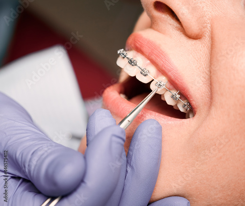 Close up of dentist hand in serial glove putting elastic rubber band on patient brackets. Woman with wired metal braces on teeth receiving orthodontic treatment in dental clinic. Concept of dentistry.