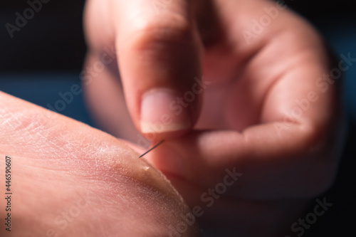 Women s fingers pierce a callus on the heel with a needle