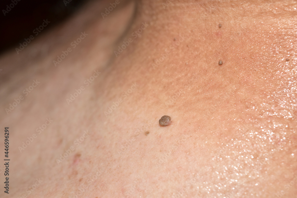 Fototapeta premium A snapshot of a papilloma located on a man's neck ..
