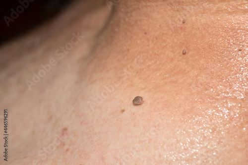 A snapshot of a papilloma located on a man s neck ..