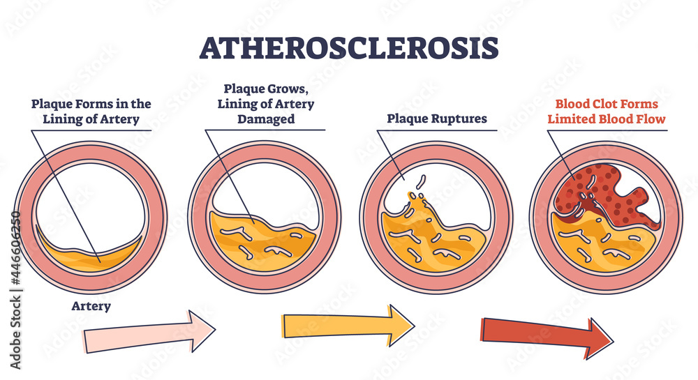 Atherosclerosis stages explanation and fatty plaque formation outline diagram. Artery side view with limited blood flow and rupture risk vector illustration. Dangerous health condition explanation.