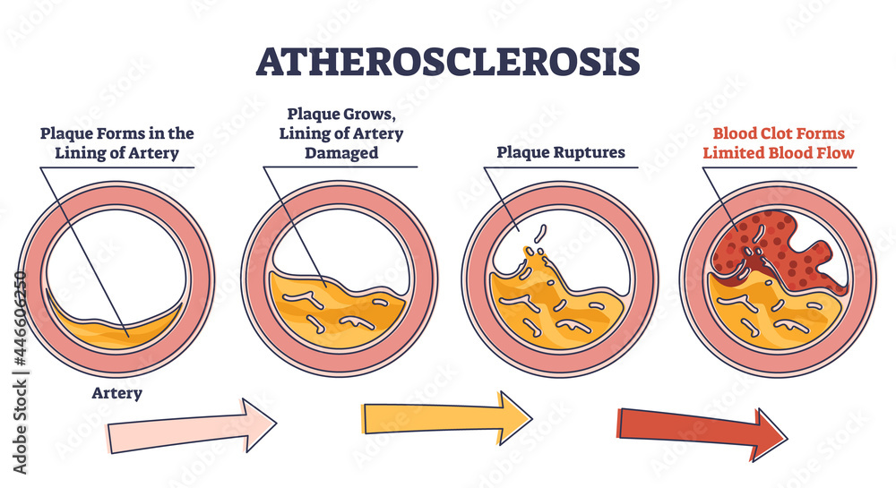 Atherosclerosis Stages Explanation And Fatty Plaque Formation Outline Atherosclerosis Stages Explanation And Fatty Plaque Formation Outline