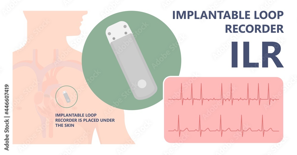 Vetor de loop holter event atrial heart attack stroke ECG EKG device