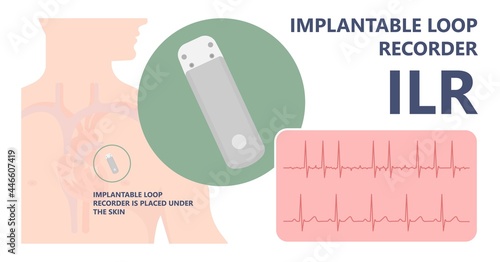 loop holter event atrial heart attack stroke ECG EKG device monitoring rhythm cardiac chest risk ILR Implantation ICD atrial rate beat pain artery pulse