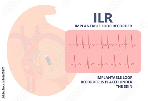 loop holter event atrial heart attack stroke ECG EKG device monitoring rhythm cardiac chest risk ILR Implantation ICD atrial rate beat pain artery pulse