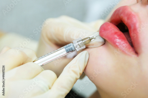 lip augmentation procedures in the beautician s office. changing the shape of the lips using a injecting method. doctor cosmetologist makes an injection in the lip of a woman