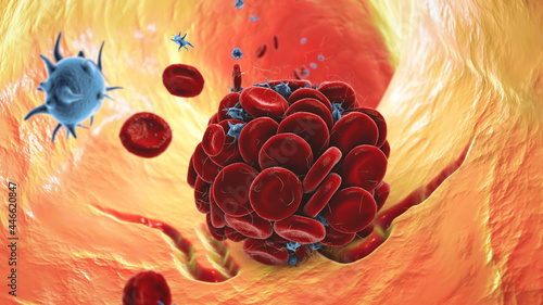 Fotografie Blood clot in damaged blood vessel made of red blood cells, platelets and fibrin