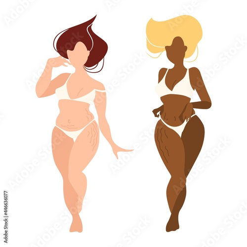 Two girls different nationalities with overweight and stretch marks on skin. Appearance problems after pregnancy in woman. Concept design of skin care and body positive. Isolated vector illustration.