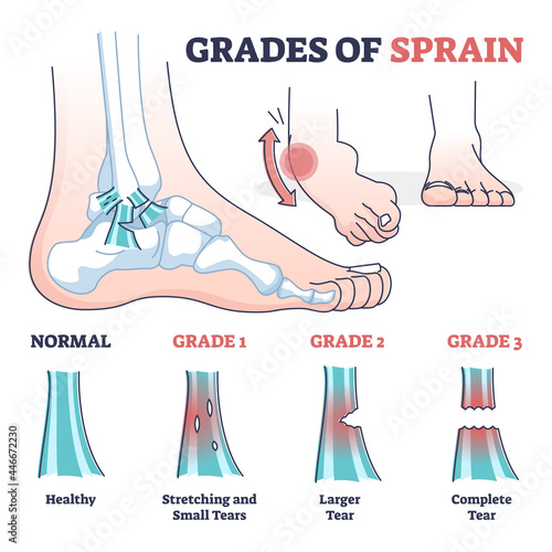 Grades of sprain as ankle or foot medical injury levels outline diagram. Anatomical leg problem significance measurement and division vector illustration. Healthy, stretching and tears explanation.