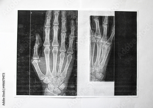 Right hand x ray image with the fourth finger broken.