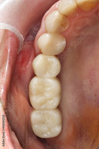 beautiful composition of the installed dental bridge made of ceramics in the area of the gusset teeth, view in the occlusion