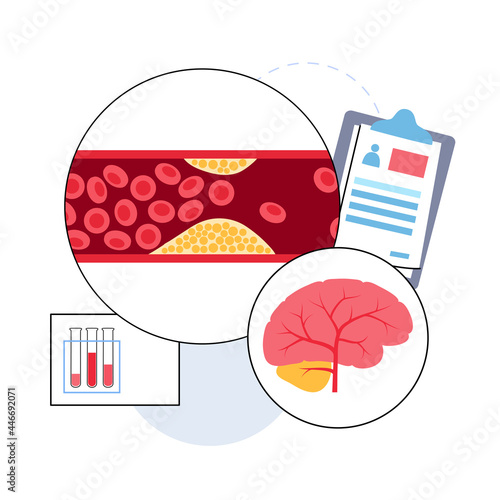 Brain stroke ishemic