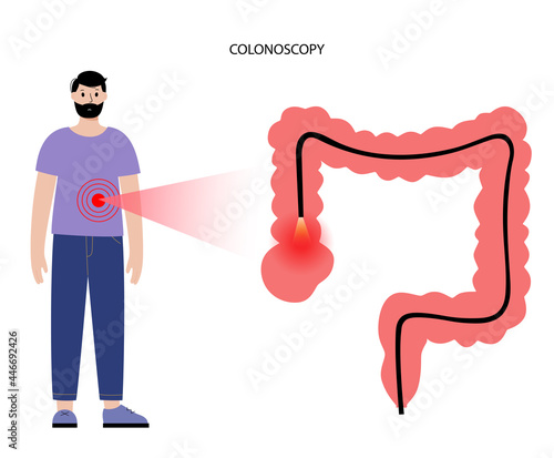 Colonoscopy procedure concept