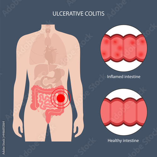 intestine ulcerative colitis