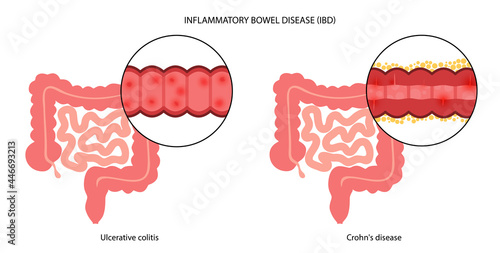 Inflammatory bowel disease