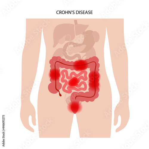 Chrons disease concept