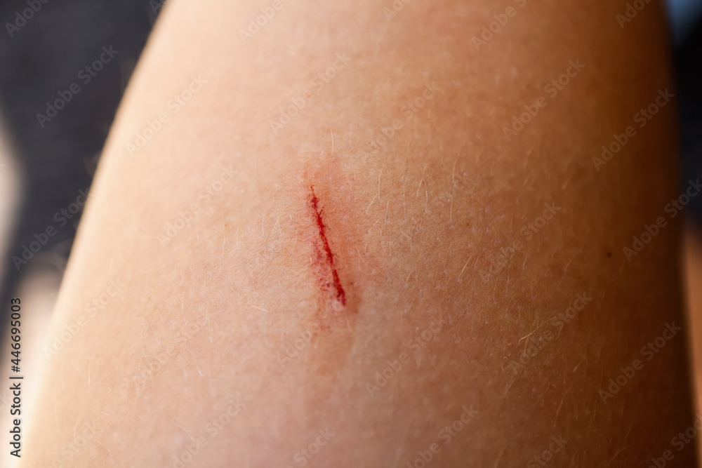 Fresh wound on the leg, thigh with blood. Skin texture. Body positive - body hair. Woman's leg. The red scratch is bleeding. First aid. Close-up