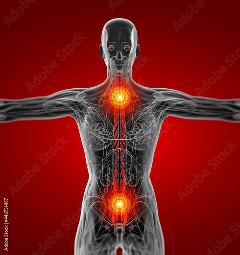 medical  illustration of the Transversospinalis photo