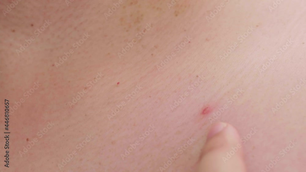 Skin problems acne and big ugly simple close up. Health and skin care concepts. Skin problems acne and big ugly simple close up. Health and skin care concepts.