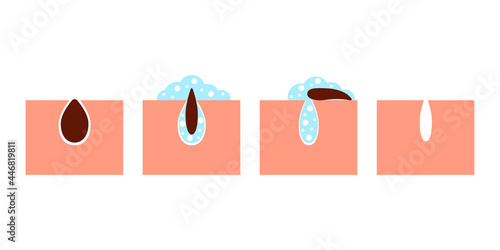 Deep cleansing of skin pores from blackheads, skin care. Procedure to wash dirt of skin of face. Removing sebum and cleaning with detergent. Vector illustration