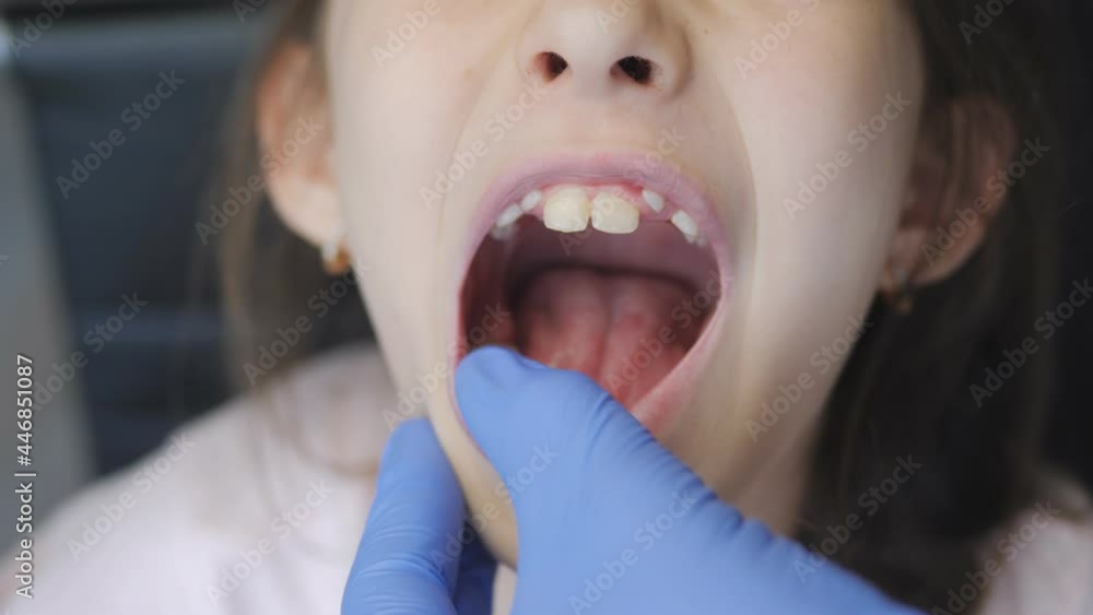 Examination of the open mouth of the child