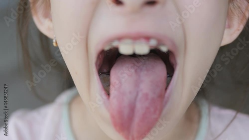 A pediatrician in medical gloves examines the mouth of a 10-year-old girl. A pediatrician examines the open mouth of a child's girl, close-up.