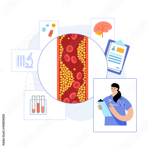 Brain stroke ishemic