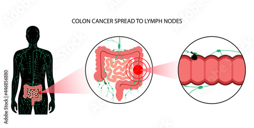 Colon cancer stage