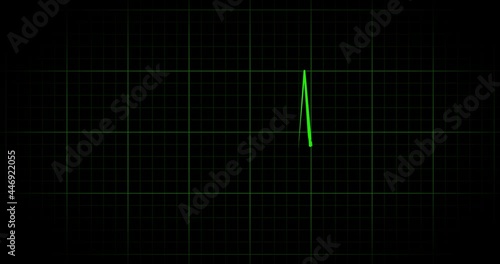 4K Fast heartbeat cardiogram on green grid on black background. Accelerated sinus rhythm and lack of heartbeat. Life and death
