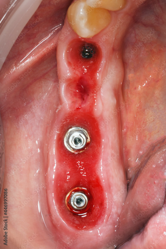 Fototapeta premium formed gingiva before prosthetics of a dental bridge for four teeth in the chewing area