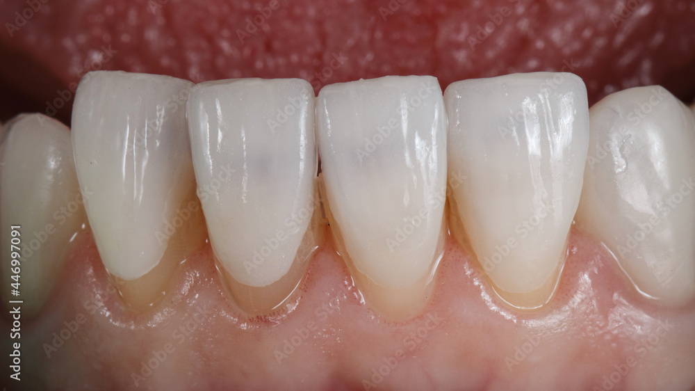 four ultra-thin dental veneers before bonding to the teeth