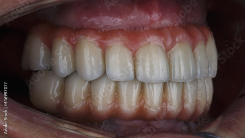 dentures in the occlusion in the oral cavity, side view