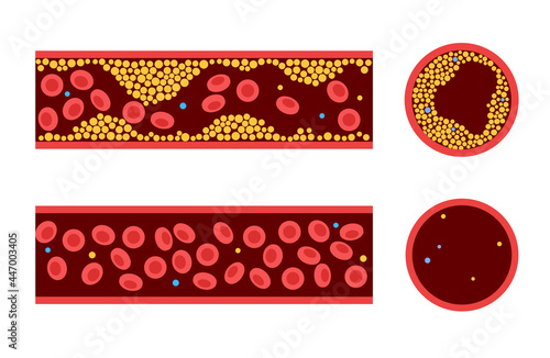Cholesterol blood artery