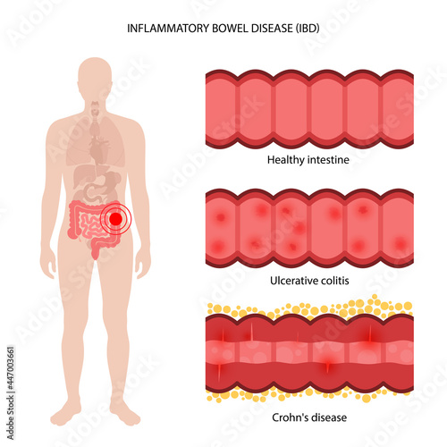 Inflammatory bowel disease