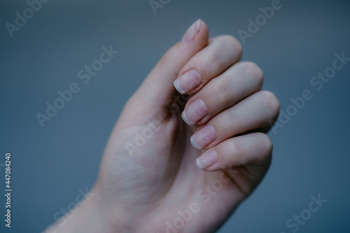 Nails and cuticle problems. Dry nails . Damaged fingernails . Chipped nails. Long fingernails and cuticles in bad condition. Chapped and neglected hands. Hands care concept. Gel nail polish fell off.  photo