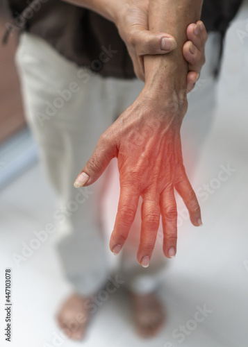 Peripheral Neuropathy pain, Guillain-Barre syndrome GBS in elderly patient on hand, finger and sensory nerves with numb, aching, muscle weakness from chronic inflammatory demyelinating polyneuropathy photo