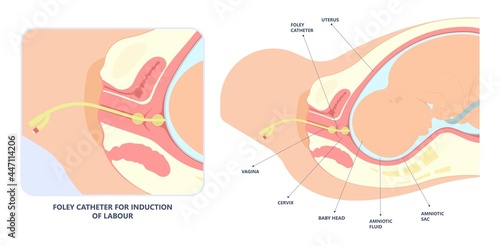 Labor swept drug baby Foley Strip sweep sac uterus hook Amnio fetus risk Cook ripe IV line bulb speed up plug mucus previa water vagina ripen first gland loop birth give method induce cervix sweeping photo