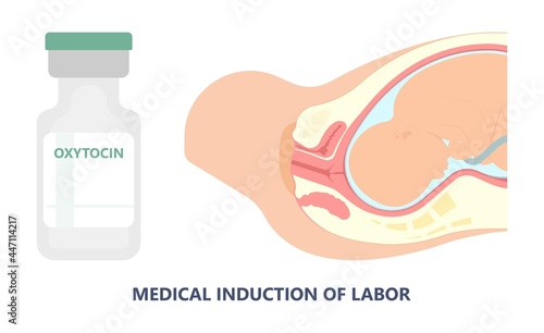 Labor swept drug baby Foley Strip sweep sac uterus hook Amnio fetus risk Cook ripe IV line bulb speed up plug mucus previa water vagina ripen first gland loop birth give method induce cervix sweeping
