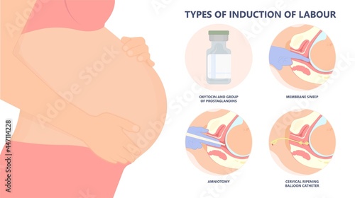 Labor swept drug baby Foley Strip sweep sac uterus hook Amnio fetus risk Cook ripe IV line bulb speed up plug mucus previa water vagina ripen first gland loop birth give method induce cervix sweeping