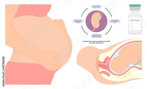 Labor swept drug baby Foley Strip sweep sac uterus hook Amnio fetus risk Cook ripe IV line bulb speed up plug mucus previa water vagina ripen first gland loop birth give method induce cervix sweeping