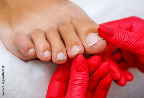 Onycholysis of toenails in a man. Healing male pedicure. The orthopedic surgeon examines the problem foot.