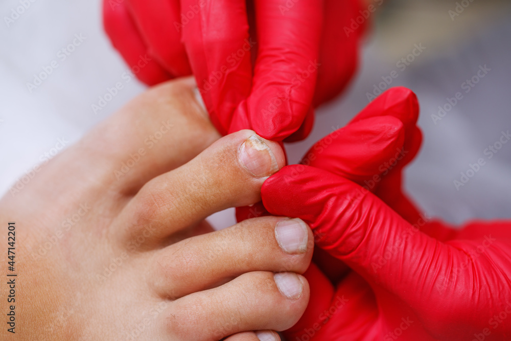 Foto de Onycholysis of toenails in a man. Healing male pedicure. The