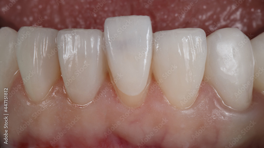 Ultra-thin Dental Viniron for the Lower Jaw Before Finixing Orthoped