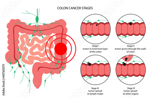Colon cancer stage