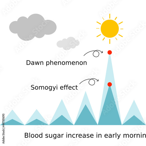 Dawn phenomenon and Somogyi effect in early morning in diabetes patient