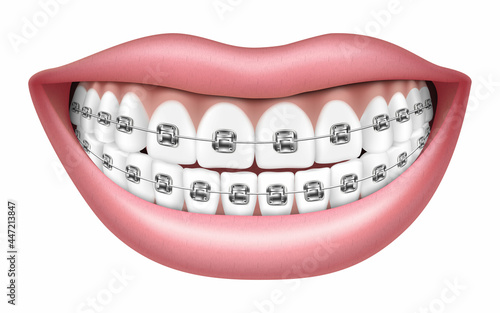 Smile with white teeth and braces. Realistic 3D Vector illustration, isolated on white background,